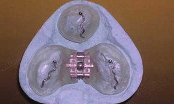 Pre surgical orthopedic plate Latham appliance